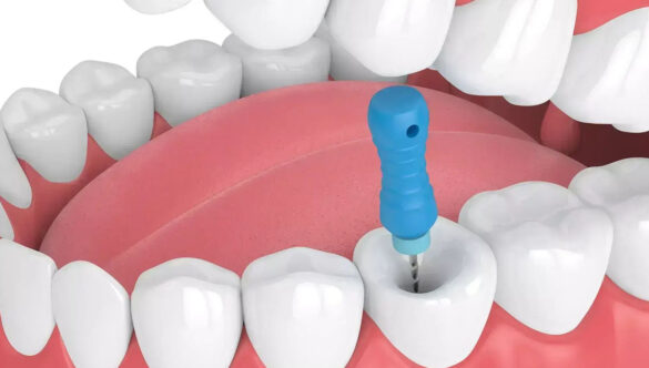 Say Goodbye to Tooth Pain: Experience Painless Root Canal at Nova Dental Hospital