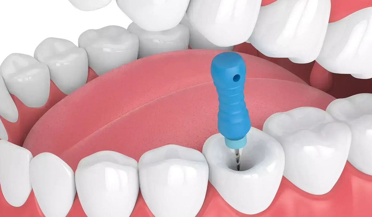 Say Goodbye to Tooth Pain: Experience Painless Root Canal at Nova Dental Hospital