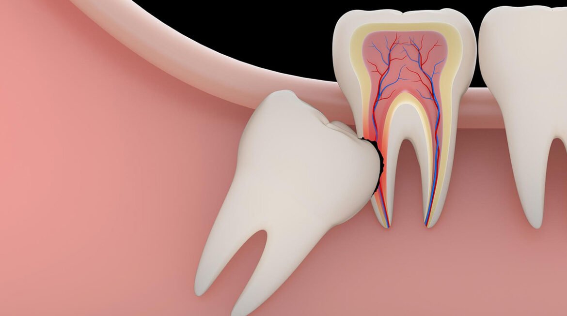 Everything You Need to Know About Wisdom Teeth: Facts, Myths, and Why Extraction Is Often the Best Option