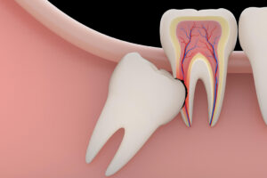 Everything You Need to Know About Wisdom Teeth: Facts, Myths, and Why Extraction Is Often the Best Option