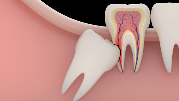 Everything You Need to Know About Wisdom Teeth: Facts, Myths, and Why Extraction Is Often the Best Option