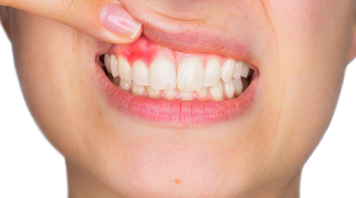Bleeding Gums Treatment: Causes, Prevention, and Solutions at Nova Dental Hospital