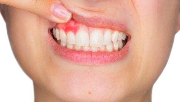 Bleeding Gums Treatment: Causes, Prevention, and Solutions at Nova Dental Hospital