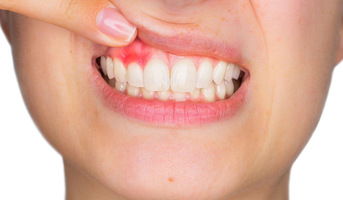 Bleeding Gums Treatment: Causes, Prevention, and Solutions at Nova Dental Hospital