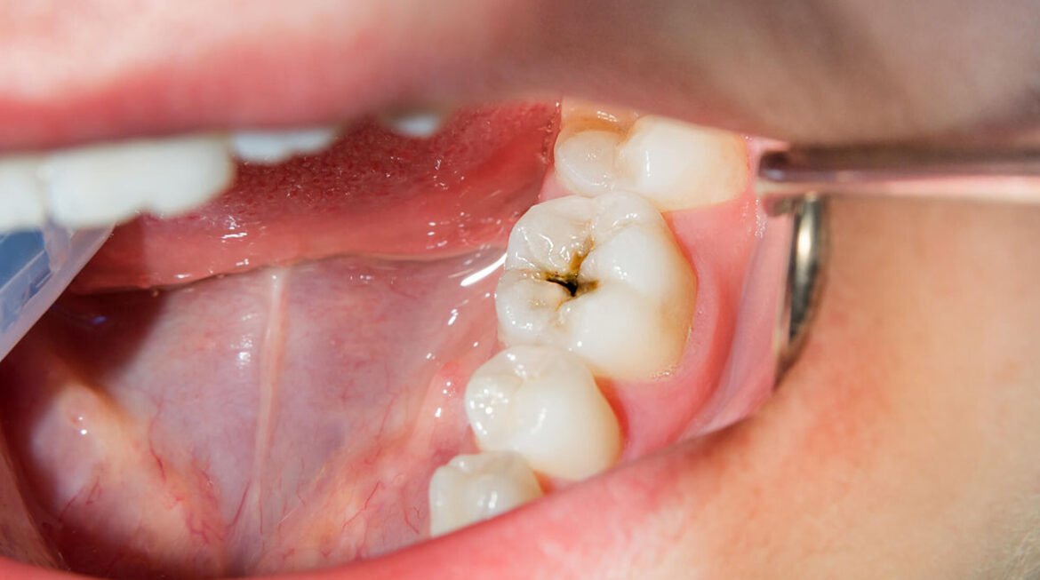 Comprehensive Cavity Protection Treatment: Safeguarding Your Oral Health