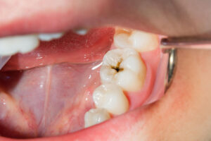 Comprehensive Cavity Protection Treatment: Safeguarding Your Oral Health