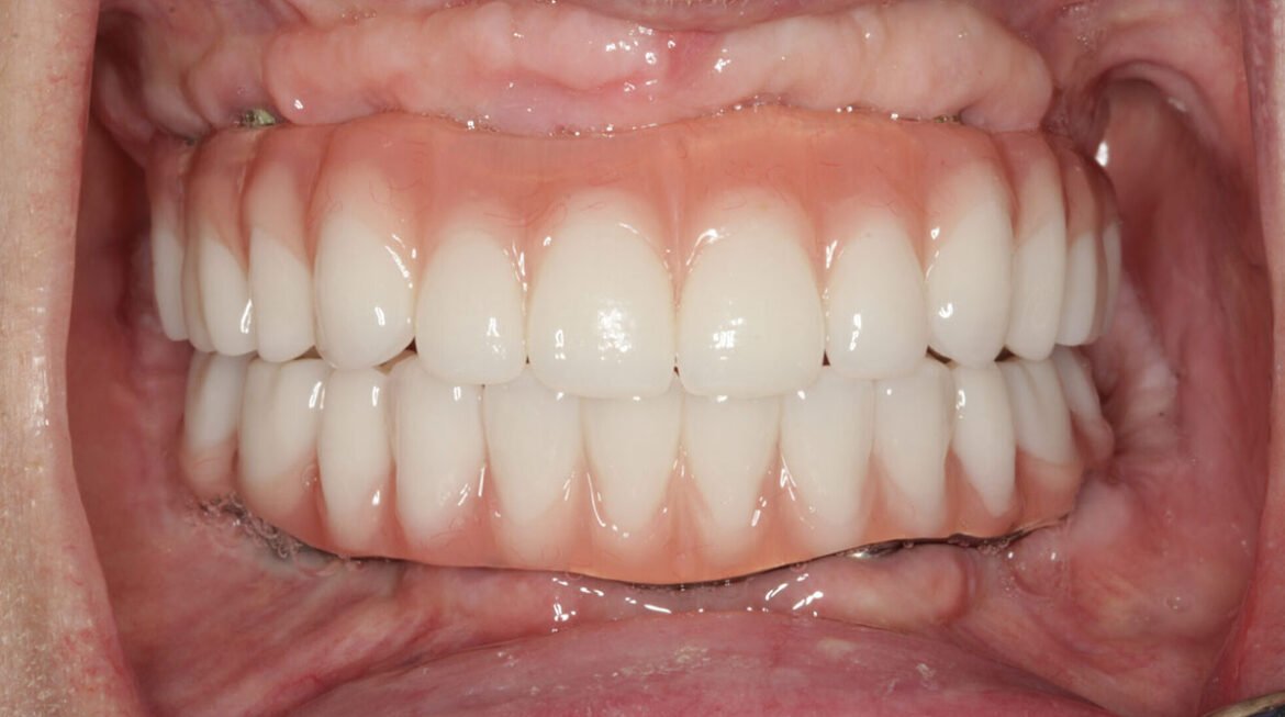 Full Mouth Rehabilitation: Transform Your Smile and Oral Health