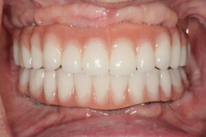 Full Mouth Rehabilitation: Transform Your Smile and Oral Health