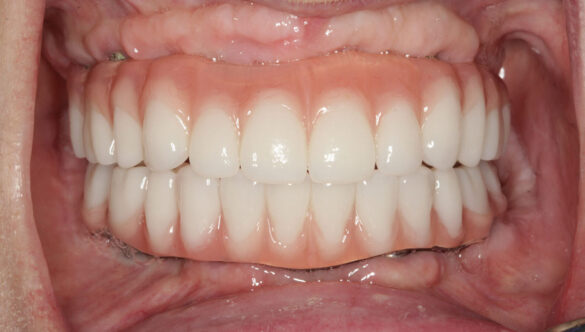 Full Mouth Rehabilitation: Transform Your Smile and Oral Health