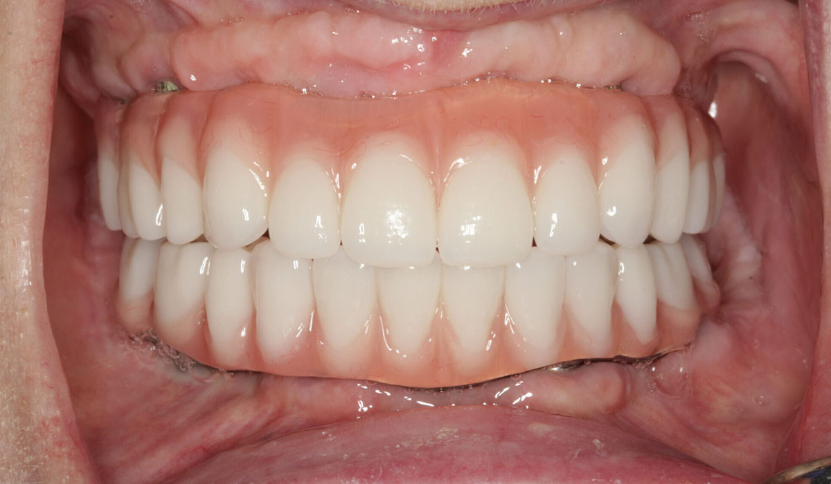 Full Mouth Rehabilitation: Transform Your Smile and Oral Health