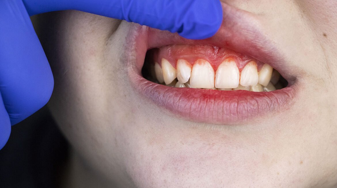 Gum Infection Treatment: Symptoms, Causes, and Effective Solutions