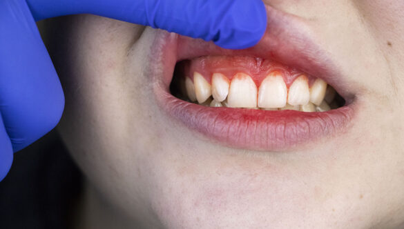 Gum Infection Treatment: Symptoms, Causes, and Effective Solutions