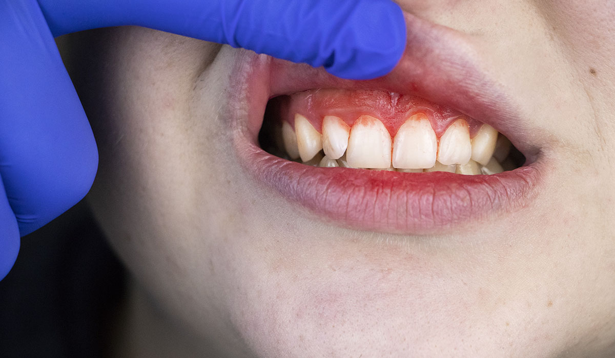 Gum Infection Treatment: Symptoms, Causes, and Effective Solutions