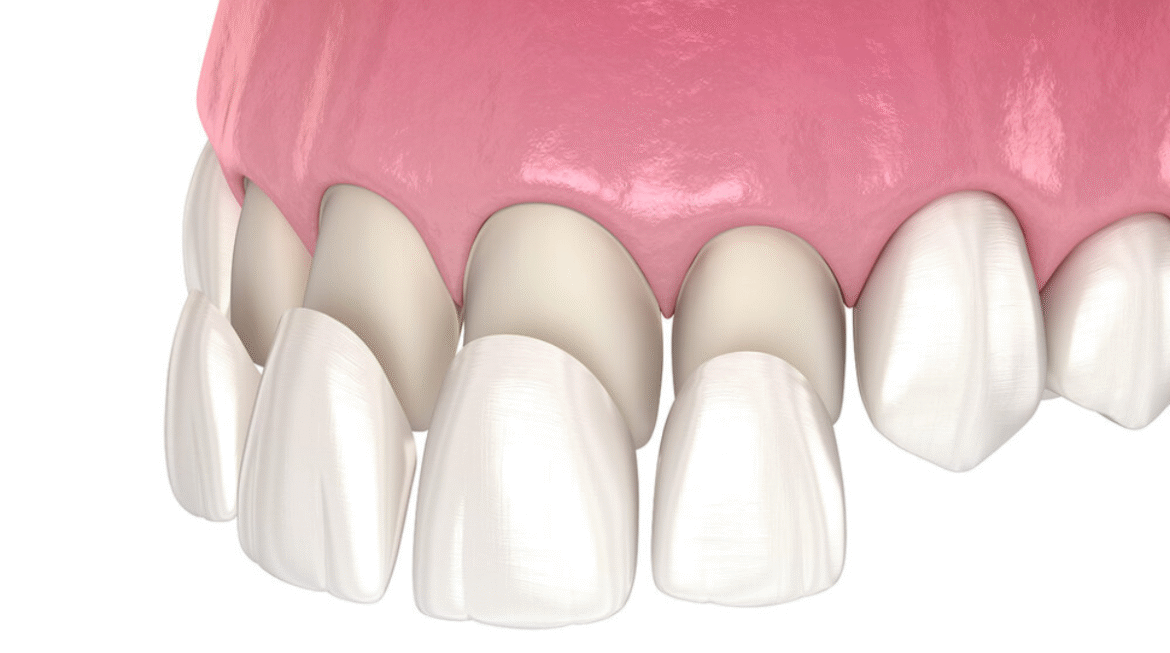 Your Guide to Dental Veneers in Gandhinagar
