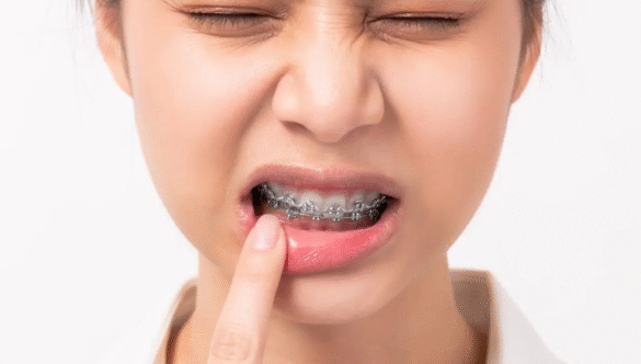 Is Truly Painless Braces Treatment Possible? Uncover the New Reality of Orthodontics