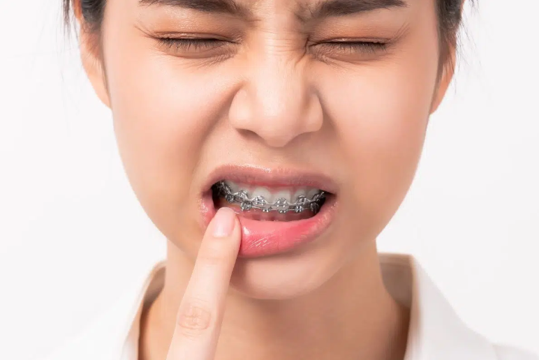Is Truly Painless Braces Treatment Possible? Uncover the New Reality of Orthodontics