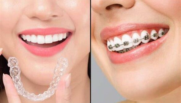 Braces vs. Invisalign: Which Orthodontic Treatment Is Right for You?