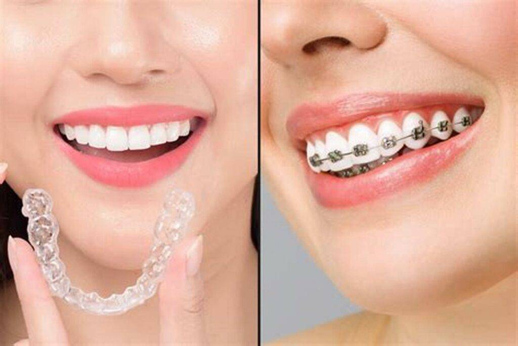 Braces vs. Invisalign: Which Orthodontic Treatment Is Right for You?