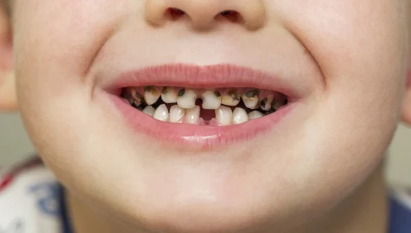 Cavities in Kids: A Parent’s Guide to Prevention, Symptoms, and Treatment