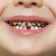 Cavities in Kids: A Parent’s Guide to Prevention, Symptoms, and Treatment