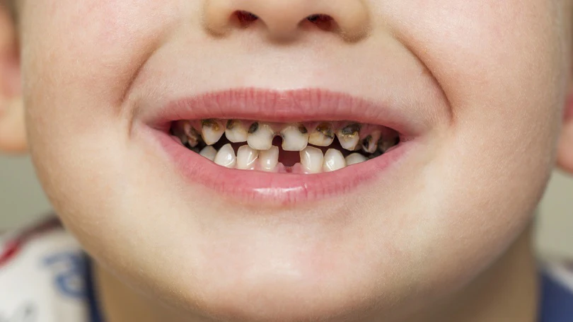Cavities in Kids: A Parent’s Guide to Prevention, Symptoms, and Treatment