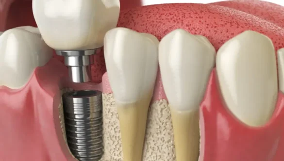 What Happens During a Dental Implant Procedure? Your Journey to a New Smile, Explained