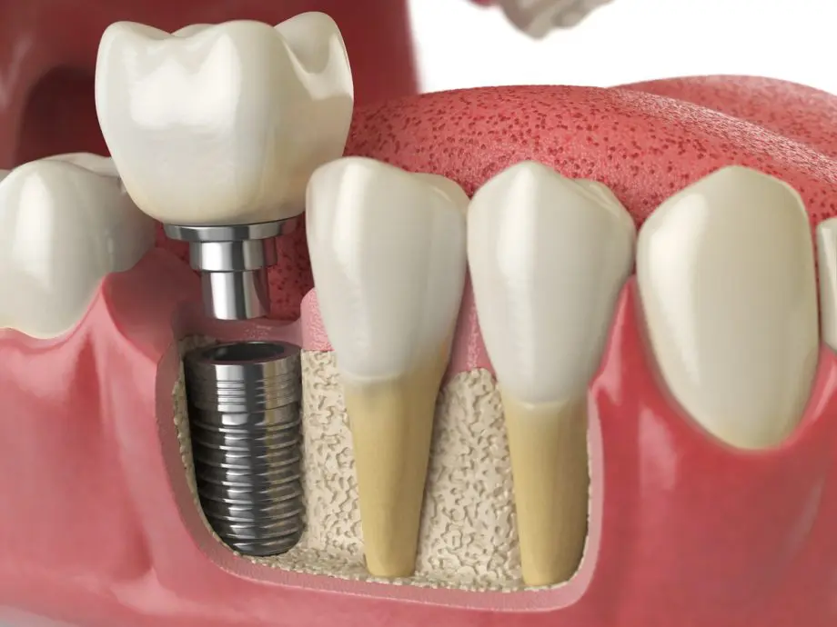 What Happens During a Dental Implant Procedure? Your Journey to a New Smile, Explained