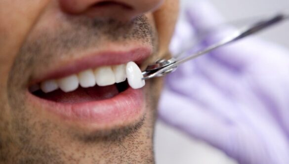 How Dental Veneers Can Fix Gaps, Stains, and Chips: Your Path to a Perfect Smile
