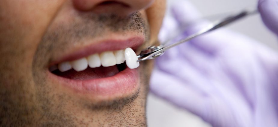 How Dental Veneers Can Fix Gaps, Stains, and Chips: Your Path to a Perfect Smile