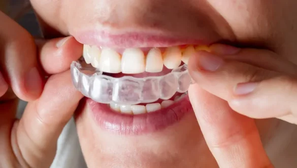 How Long Will I Have to Wear Invisalign Aligners? Your Personalized Invisalign Timeline Explained