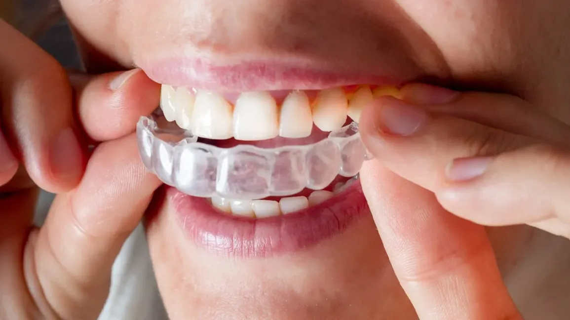 How Long Will I Have to Wear Invisalign Aligners? Your Personalized Invisalign Timeline Explained
