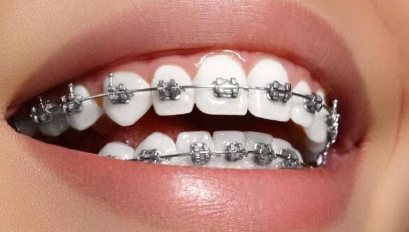 Dental Braces in Gandhinagar