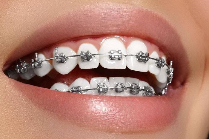 Dental Braces in Gandhinagar