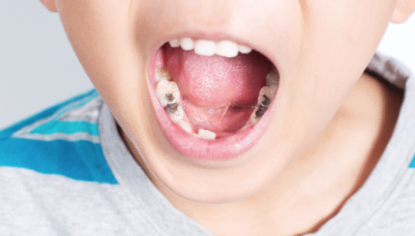 How to Prevent Cavities in Kids: A Guide for a Lifetime of Healthy Smiles