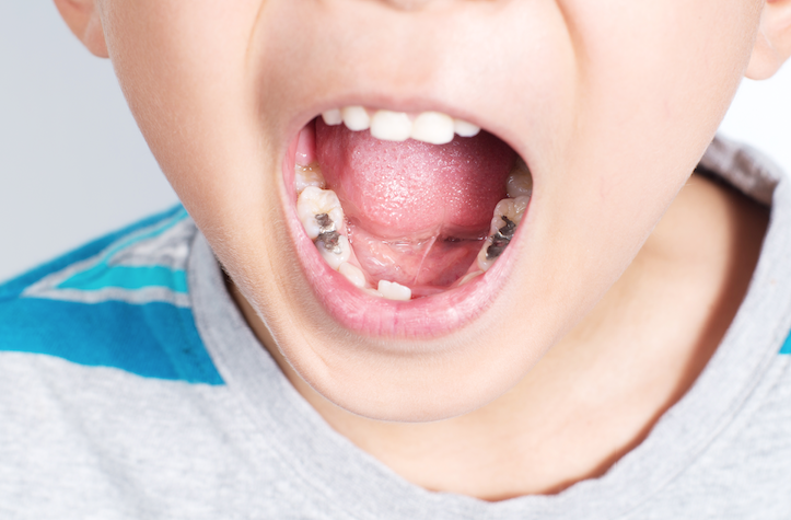 How to Prevent Cavities in Kids: A Guide for a Lifetime of Healthy Smiles