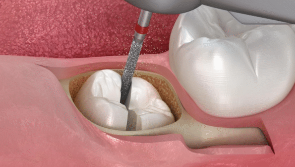 Do All Wisdom Teeth Need to Be Removed? A Wisdom Teeth Removal Guide to When, Why, and How