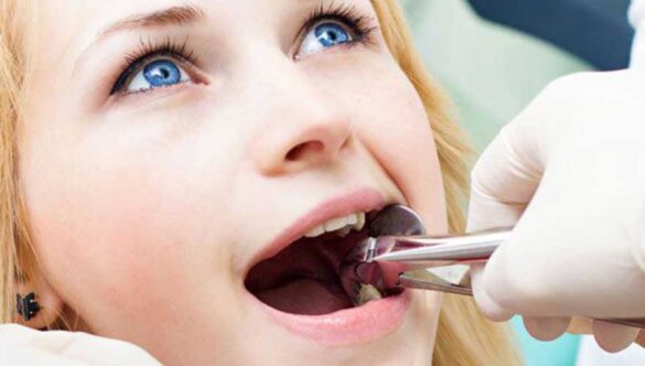 What Can I Expect From a Wisdom Teeth Removal and Recovery?