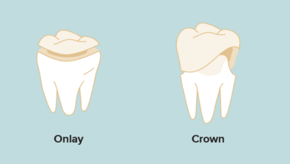 Dental Crowns vs. Onlays: Your Definitive Guide to Restoring a Healthy Smile