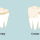 Dental Crowns vs. Onlays: Your Definitive Guide to Restoring a Healthy Smile