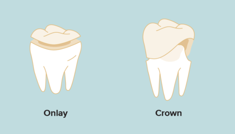 Dental Crowns Vs Onlays Your Guide Nova Dental Hospital Dental Crowns Vs Onlays Your Guide Nova Dental Hospital