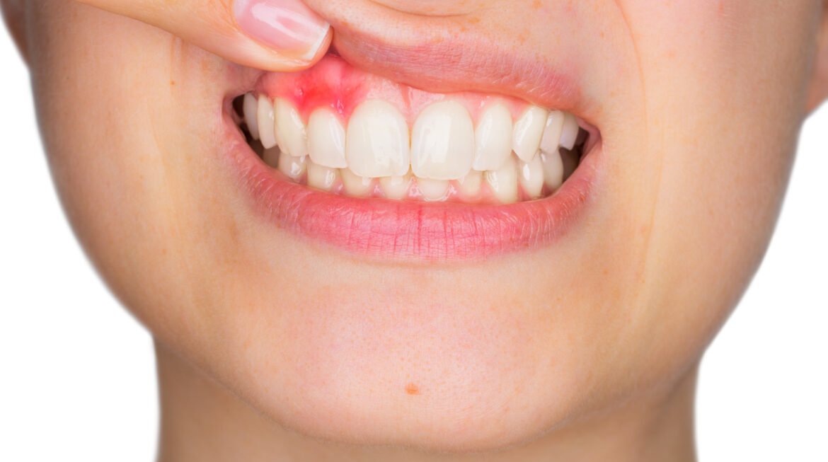 Why Are My Gums Bleeding?