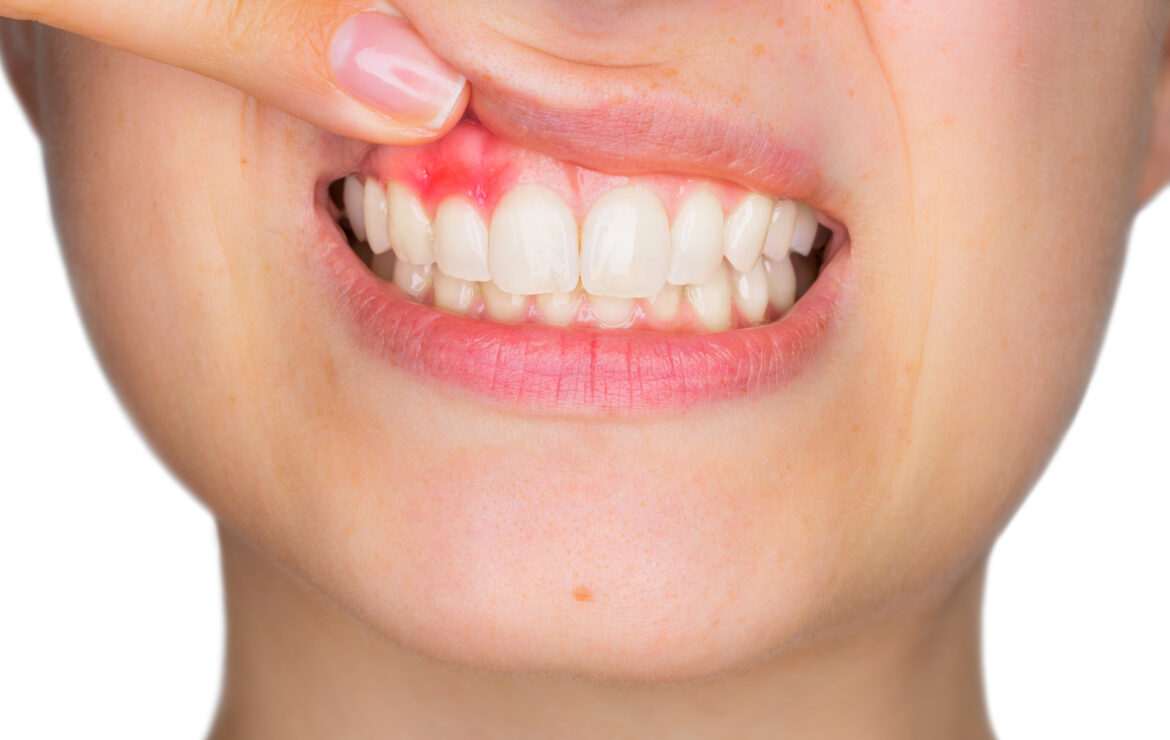 Why Are My Gums Bleeding?
