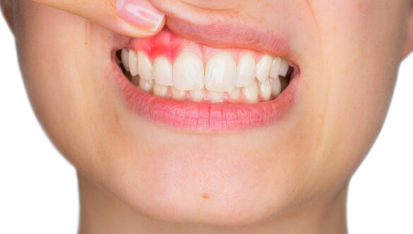 Why Are My Gums Bleeding?