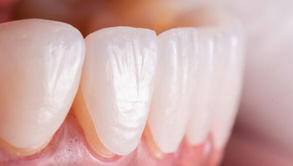 Can Veneers Fix Gaps in Teeth?: Your Guide to a Smile Makeover