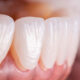 Can Veneers Fix Gaps in Teeth?: Your Guide to a Smile Makeover