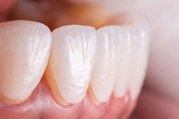 Can Veneers Fix Gaps in Teeth?: Your Guide to a Smile Makeover