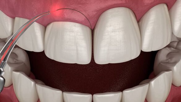 Is Gum Surgery Safe: A Comprehensive Guide to Recovery and Results