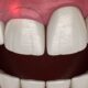 Is Gum Surgery Safe: A Comprehensive Guide to Recovery and Results
