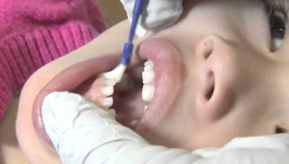 Do Kids Need Fluoride Treatments?: An Essential Guide for Parents on Pediatric Fluoride Treatment