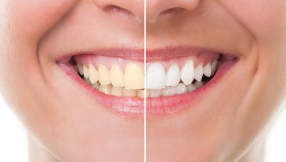 Teeth Whitening vs. Veneers: Your Guide to a Smile Makeover
